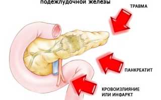 Диагностика и лечение кисты поджелудочной железы