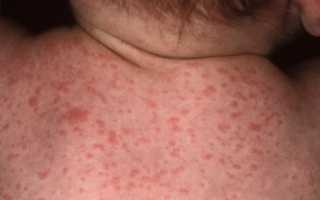 Дифференциальная диагностика и лечение вирусной экзантемы у ребенка