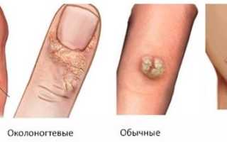 Папилломы и бородавки: особенности болезни