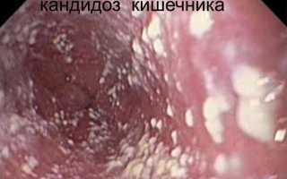 Лечение и профилактика анального кандидоза