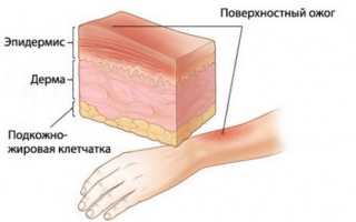 Сколько заживают ожоги разной степени тяжести?