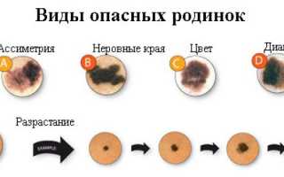 Значение родинок на пальцах рук и от каких стоит избавиться