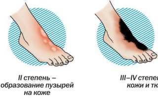 Признаки ожога 1 степени и его лечение