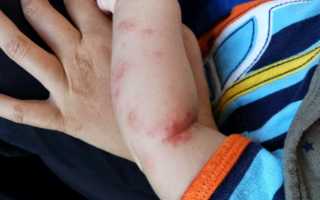 Методы избавления от зуда при заражении вирусом Коксаки