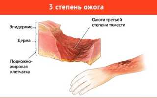 Первая помощь и лечение при ожоге 3 степени