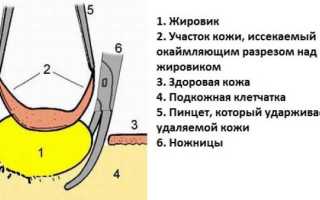 Процедура удаления жировиков лазером