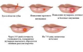 Что делать с красными пятнами после герпеса: профилактика и удаление шрамов