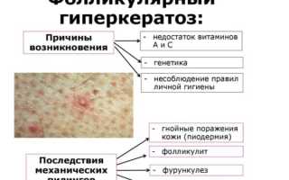 Диагностика и лечение фолликулярного кератоза у взрослых и детей