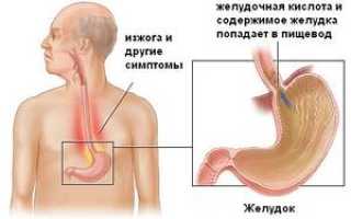 Эрозивный эзофагит: как выявить и что требуется для его лечения