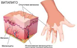 Причины возникновения, симптоматика и лечение витилиго