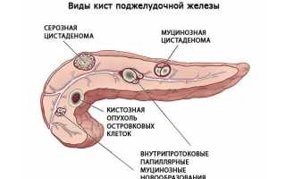 Полипы в поджелудочной железе — причины и лечение