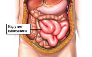 Причины вздутия кишечника, его симптомы и лечение