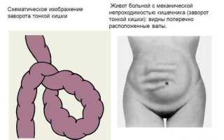 Причины и симптомы загиба кишечника, его лечение