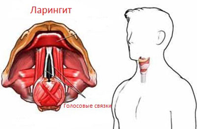 Признаки ларингита