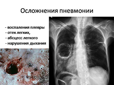 осложнения