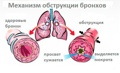 обструкция бронхов