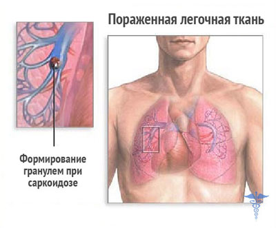 поражение легких саркоидозом