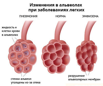 Изменения в легких при воспалении