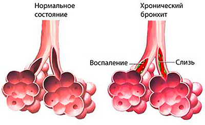 хронический бронхит