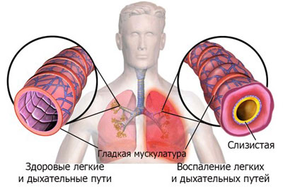 воспаление легких