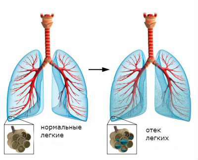 отек легких