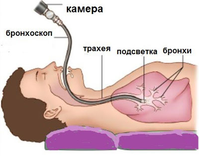 Проведение бронхоскопии