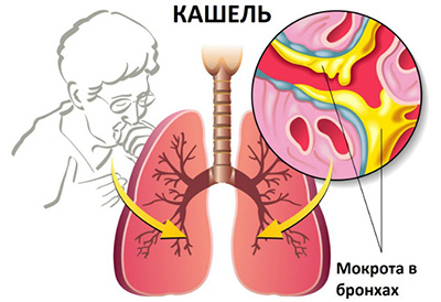 картинка: кашель и мокрота