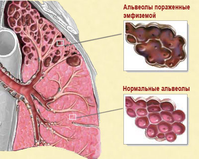 Схема легких при эмфиземе