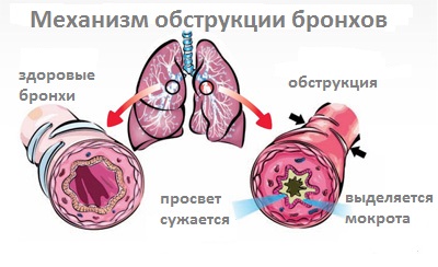 Схема бронхита