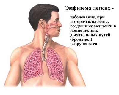 Понятие эмфиземы легких