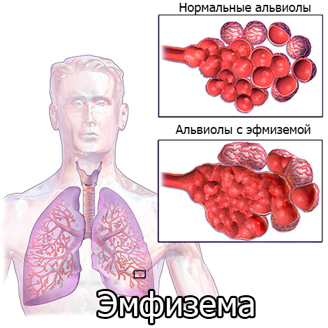 эмфизема легких рисунок