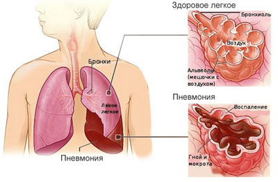 Левосторонняя пневмония