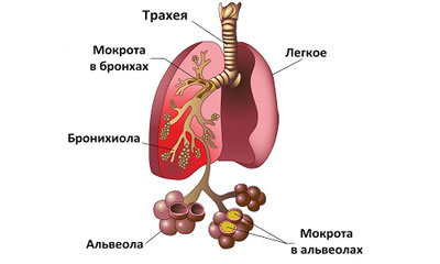 мокроты при пневмонии