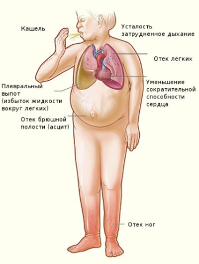 симптомы отека легких