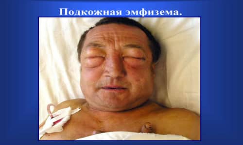 Подкожная эмфизема представляет собой скопление воздуха в органах или тканях