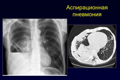 Аспирационная пневмония на рентгене